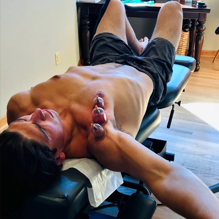 Cupping patient with cup therapy on his arm.